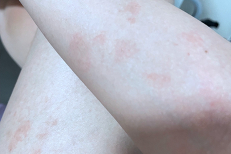 过敏性皮炎胳膊红斑图 过敏性皮炎胳膊红斑图