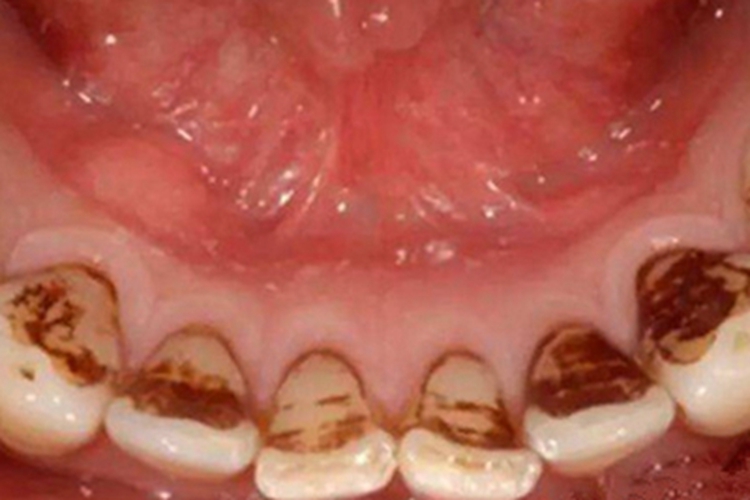 外源性色素沉着牙齿内侧有黑斑图 外源性色素沉着牙齿内侧有黑斑图