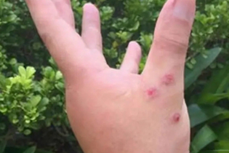 蚊虫叮咬手指长疹子图 蚊虫叮咬手指长疹子图