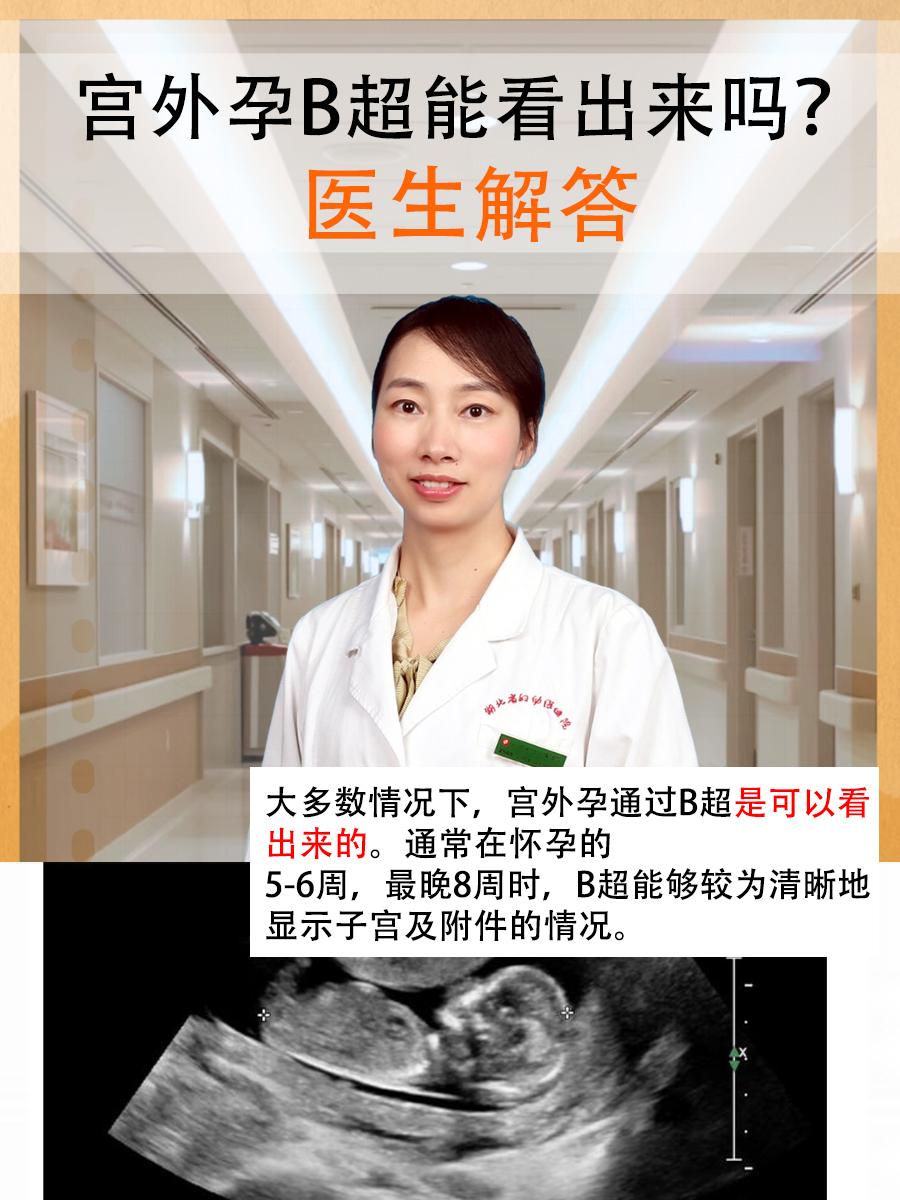 宫外孕B超能看出来吗？医生解答