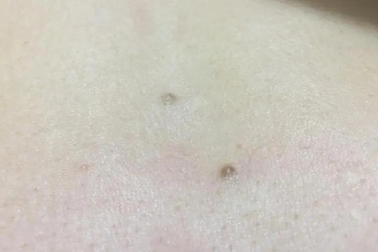 胸前皮肤纤维瘤图