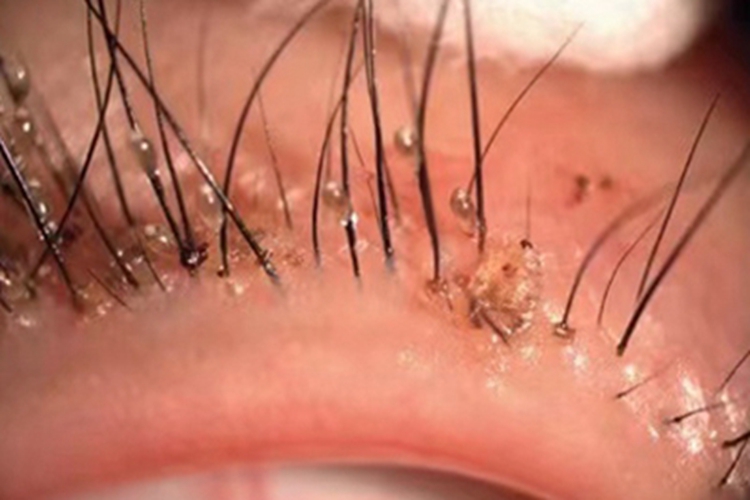 阴虱病睫毛症状图
