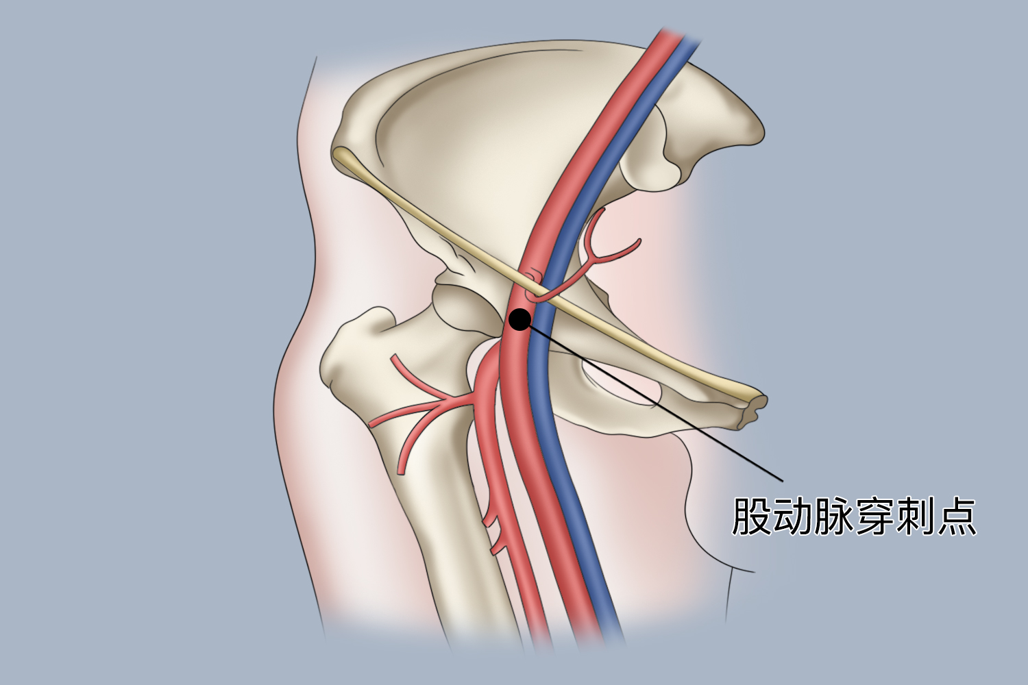 小儿股动脉穿刺定位图解