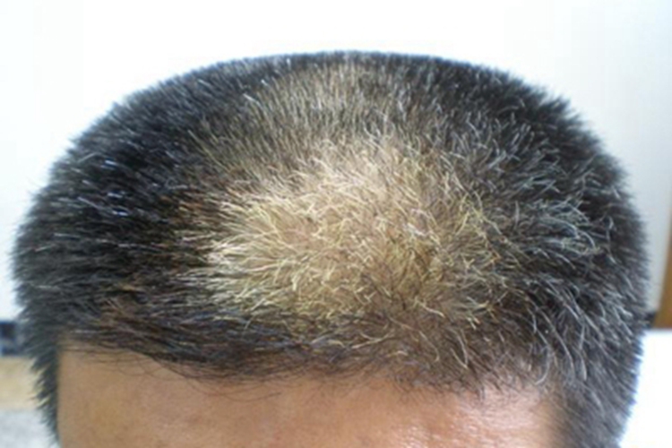 斑状白化病毛发变白图 斑状白化病毛发变白图