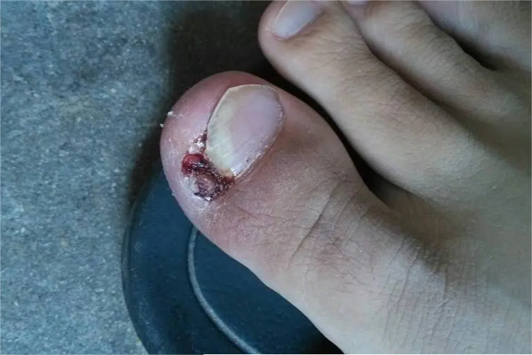 化脓性甲沟炎脚趾血痂