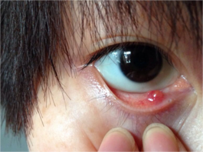 内睑腺炎下眼睑内长了个小红疙瘩图