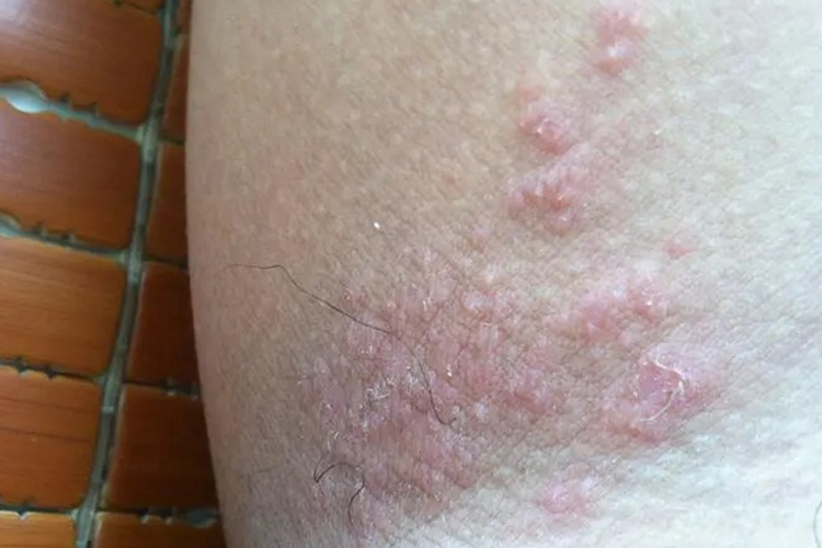 大腿窝两侧湿疹图