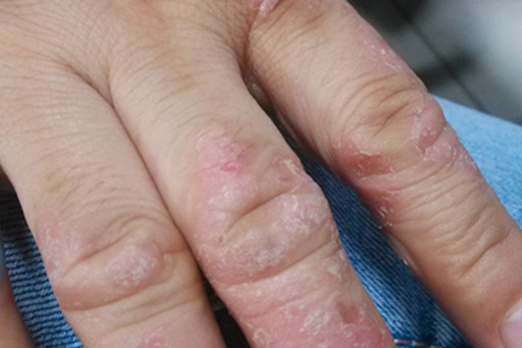 更年期角皮症手指红斑脱皮图