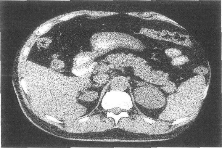 肾上腺正常CT表现图