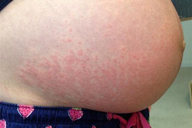 妊娠多形疹腹部小红疙瘩图 妊娠多形疹腹部小红疙瘩图