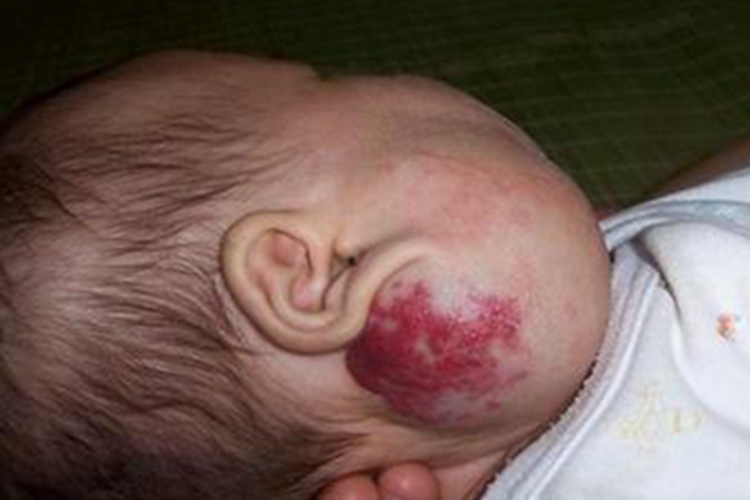 混合型婴儿血管瘤面部肿块红斑图