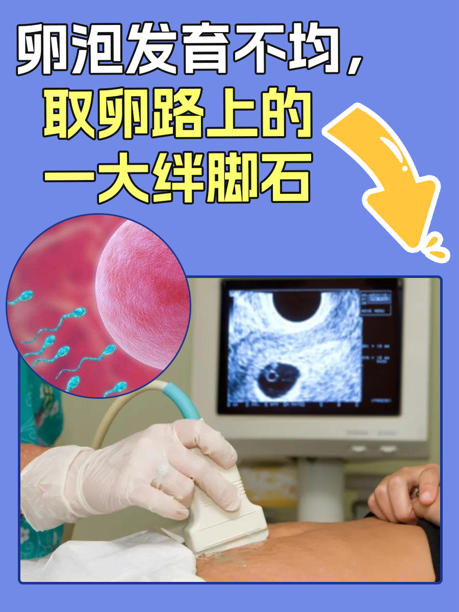 卵泡发育不均，取卵路上的一大绊脚石