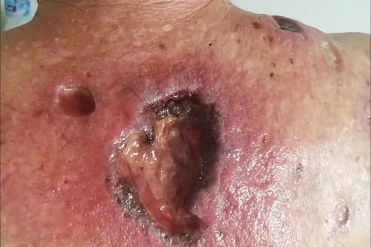 溃疡型坏疽性脓皮病背部烂成坑图