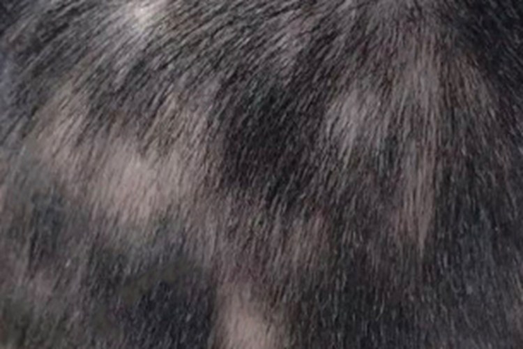 女性二期梅毒梅毒性秃发图 女性二期梅毒梅毒性秃发图