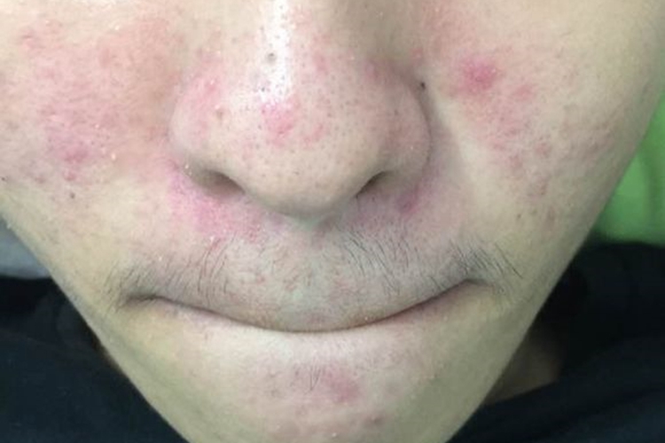 脸上螨虫图 脸上螨虫图