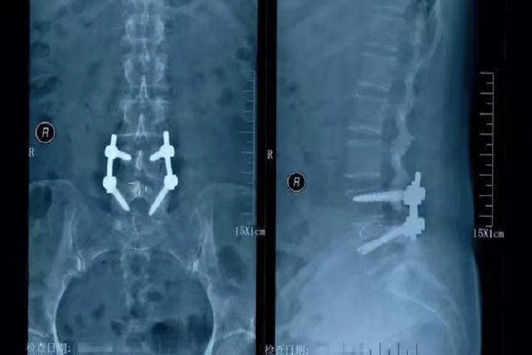 腰椎滑脱手术钉子图