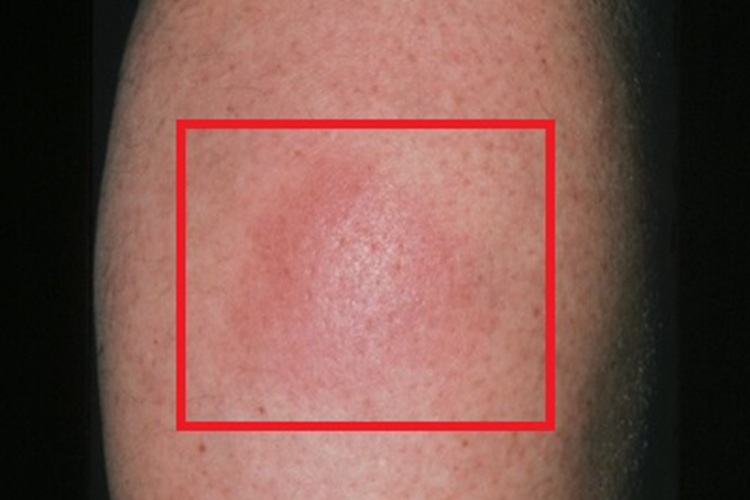 结节性红斑腿红斑图