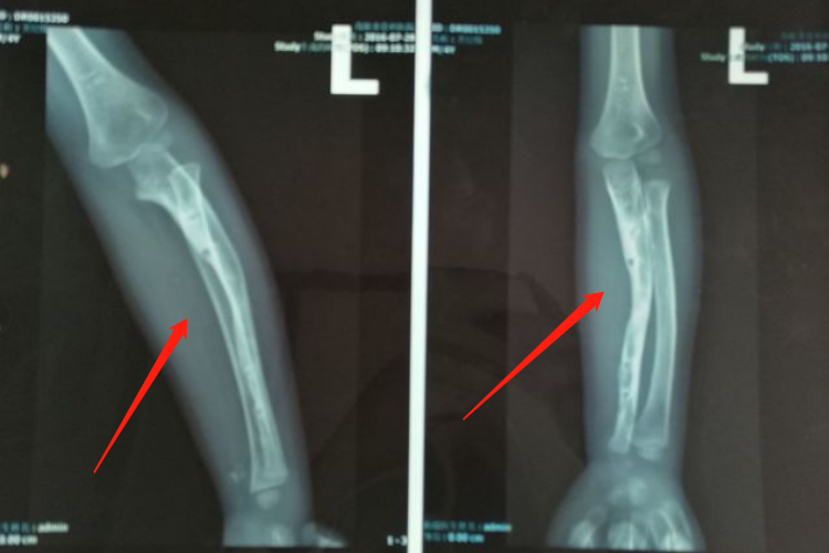 骨延长骨性骨痂成形图