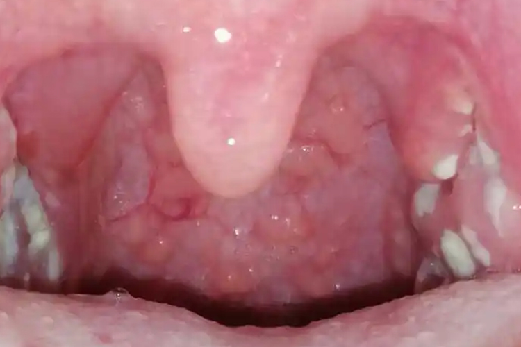 急性化脓性扁桃体炎图 急性化脓性扁桃体炎图