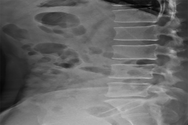 腰椎生理前凸完全消失图