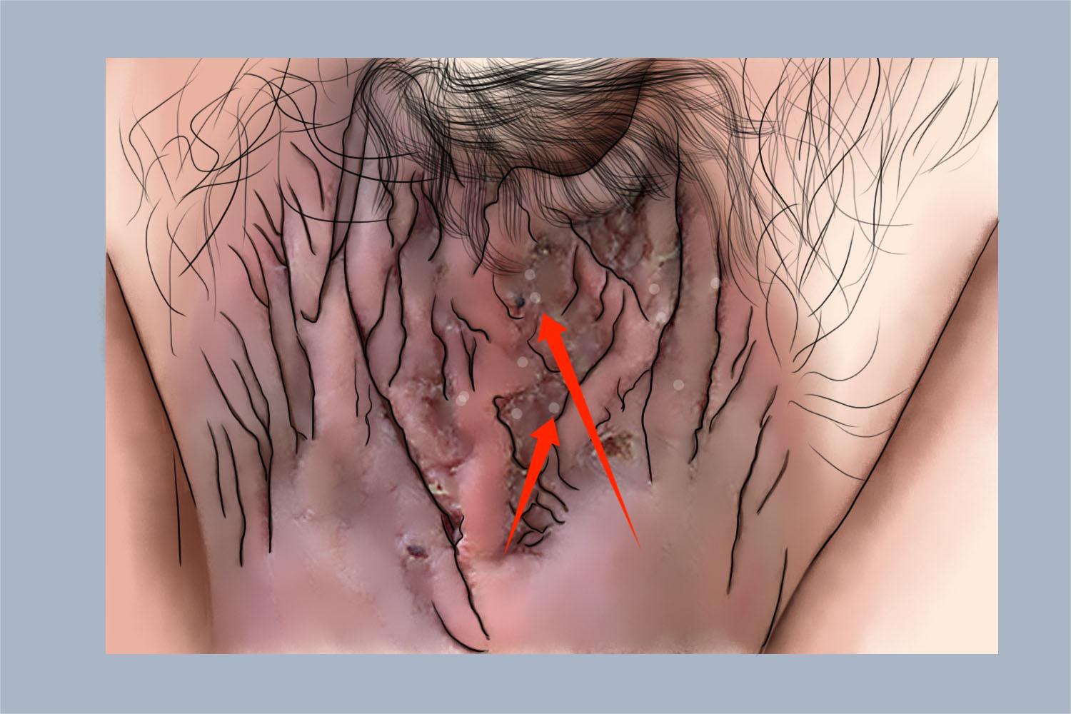 慢性湿疹阴囊症状图