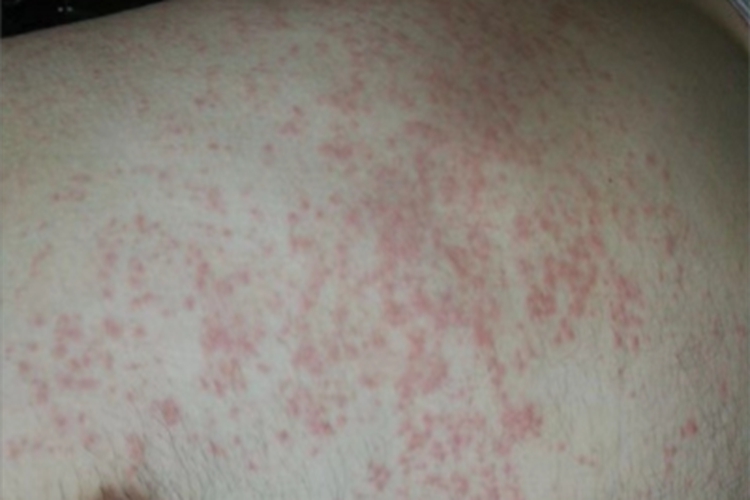 亚急性湿疹腹部小红疙瘩图