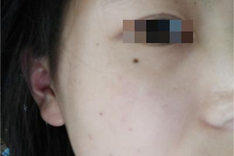 交界痣脸上有黑色的点图 交界痣脸上有黑色的点图