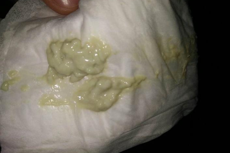 大量豆腐渣样白带图 大量豆腐渣样白带图