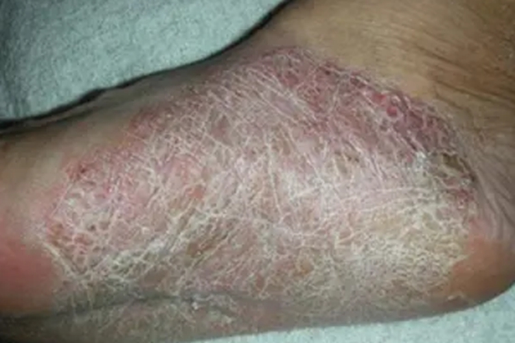 鳞屑角化型足癣脚底症状图