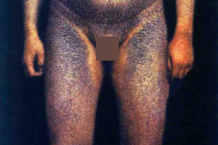 鱼鳞病全身皮肤发黑图