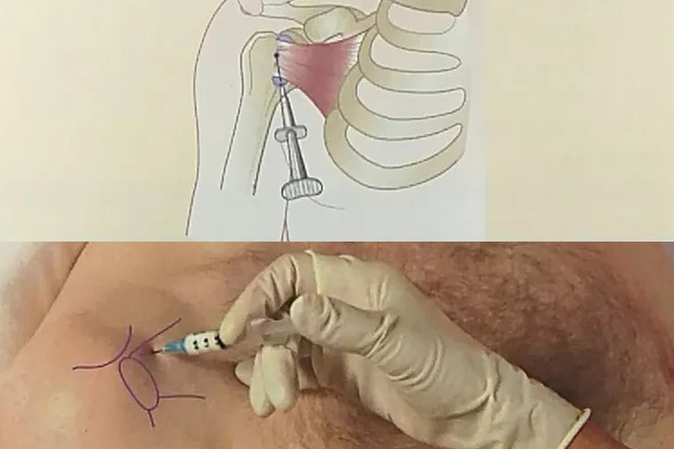肩关节腔前方穿刺图 肩关节腔前方穿刺图