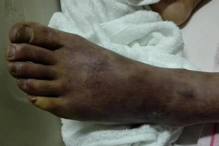 下肢动脉血栓组织坏死图