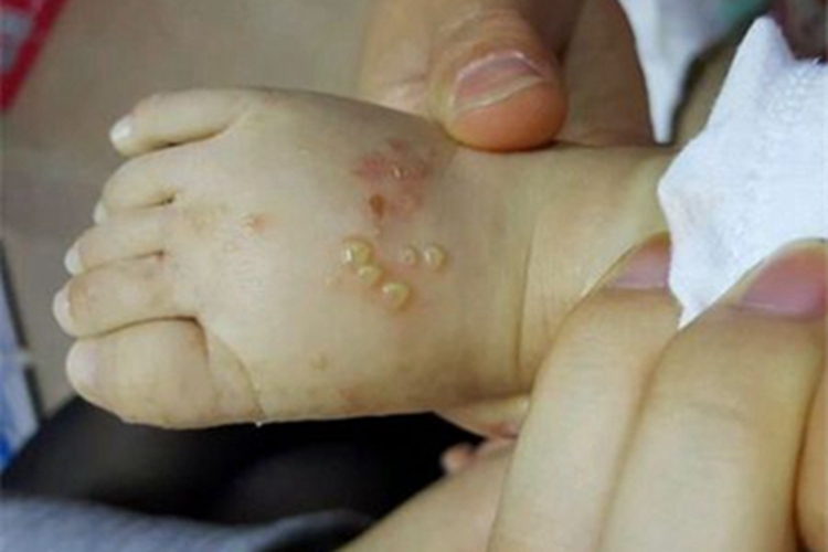 脓疱病脚背症状图 脓疱病脚背症状图