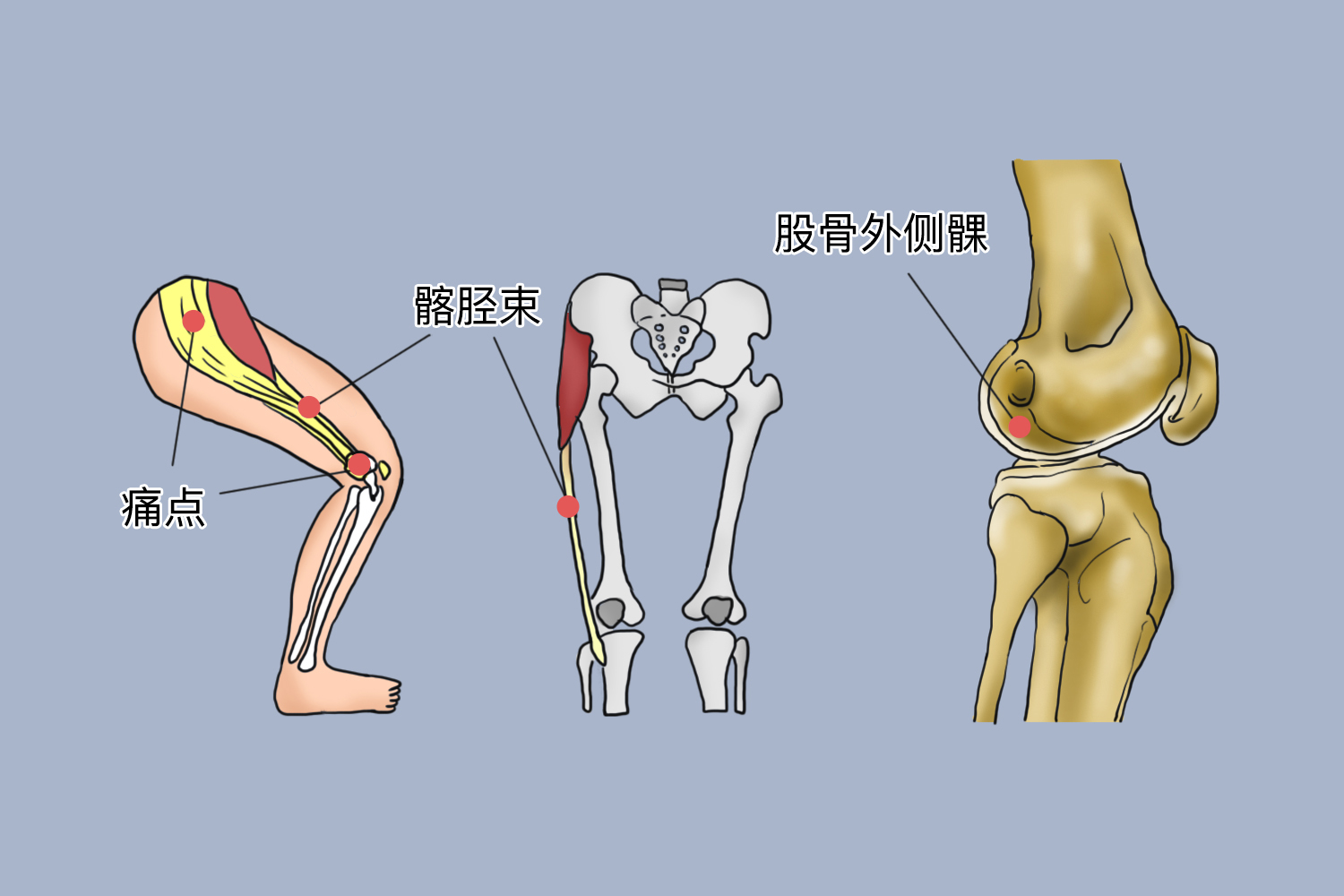 髂胫束摩擦综合征痛点图