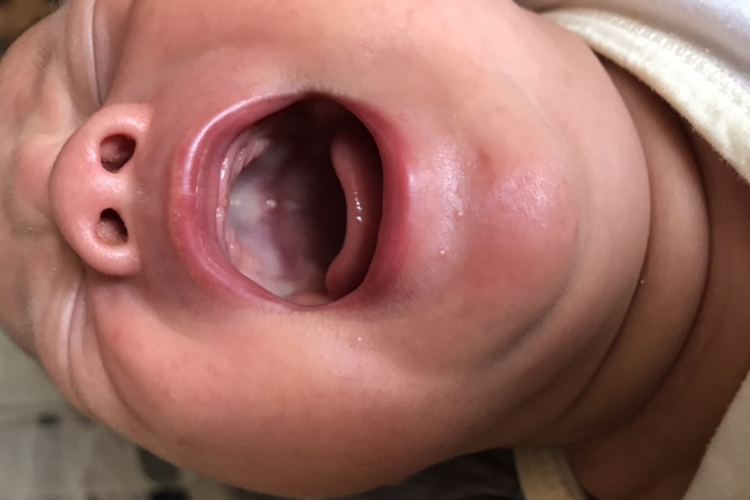 婴儿喝奶烫伤口腔图