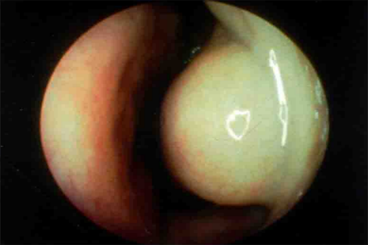 鼻甲肥大鼻黏膜有肿胀图