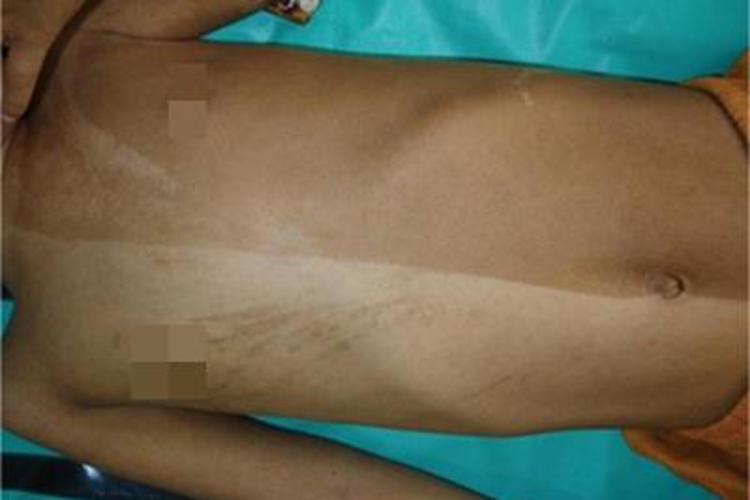 脱色性色素失禁症胸部斑图