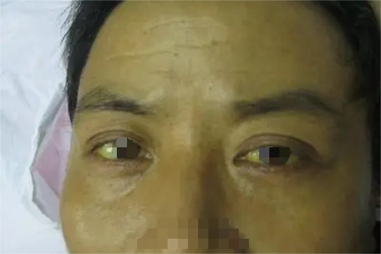 肝硬化患者黄疸图 肝硬化患者黄疸图