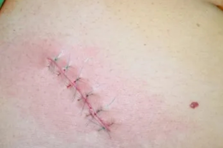 右下腹麦氏点部位开刀图 右下腹麦氏点部位开刀图