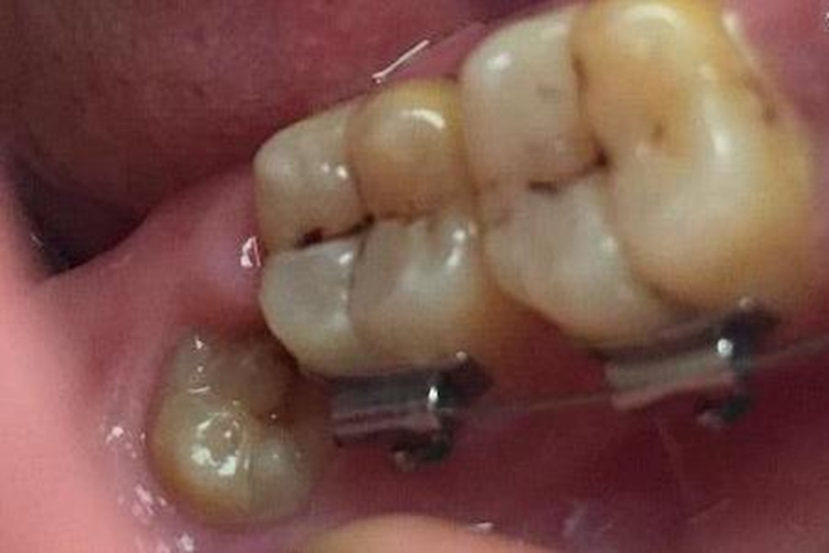 下颌阻生第三磨牙图