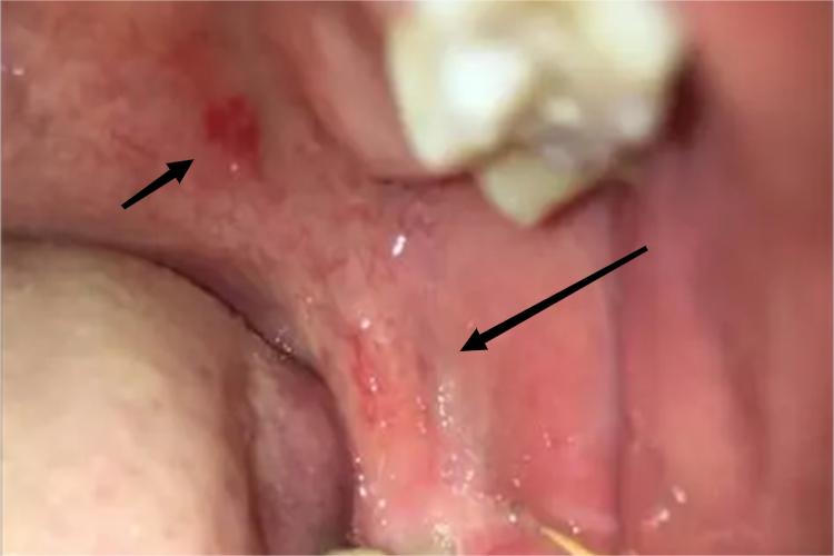 均质型口腔红斑症状图