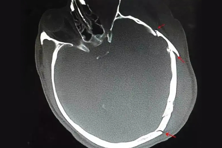 颅骨骨折CT影像表现图 颅骨骨折CT影像表现图