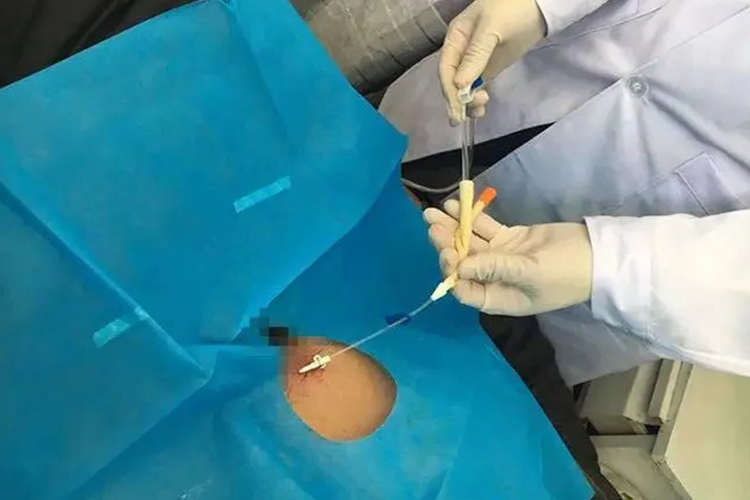 膀胱造瘘导尿管使用图