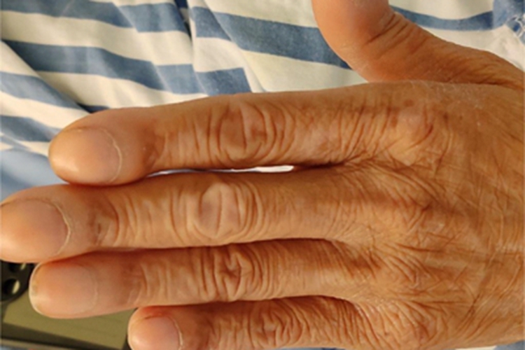 杵状指手指增厚图 杵状指手指增厚图