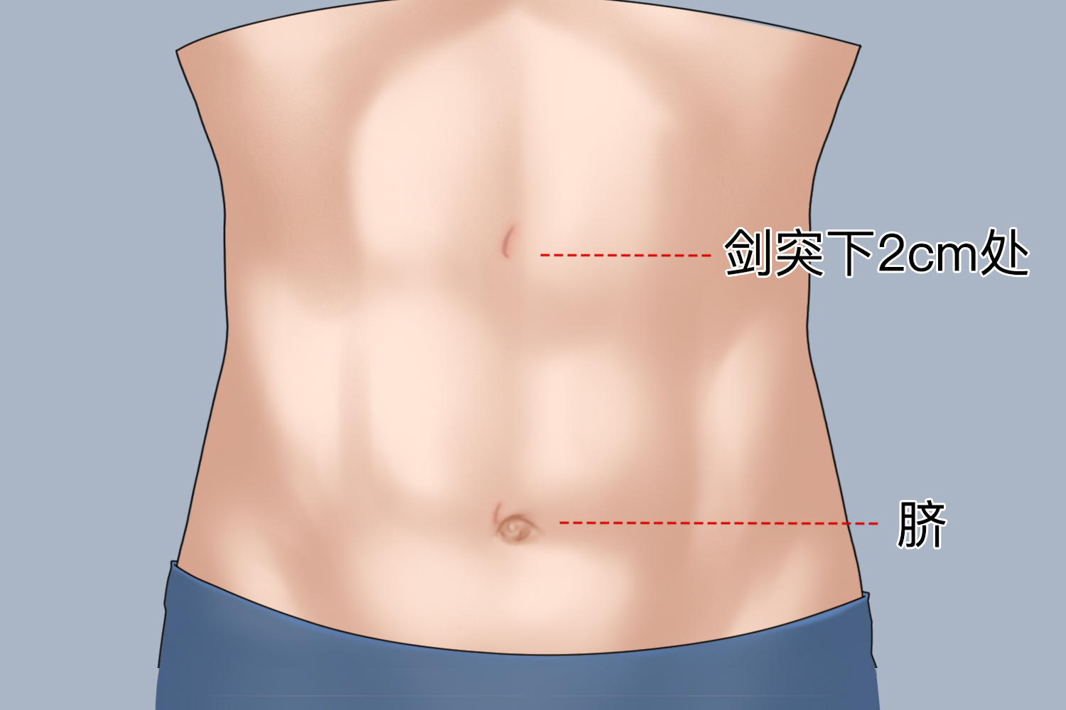 胆结石手术打两孔图片 胆结石手术打两孔图片
