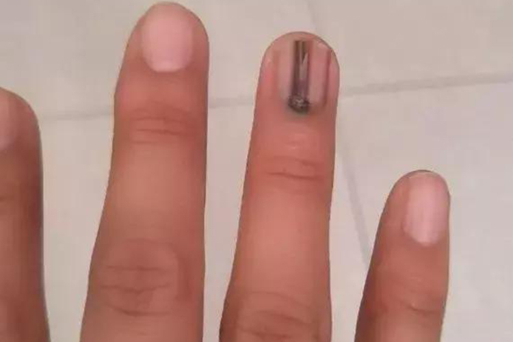 感染性心内膜炎指甲下线状出血图