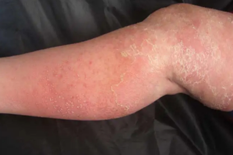 嗜酸性脓疱性毛囊炎小腿脱屑图