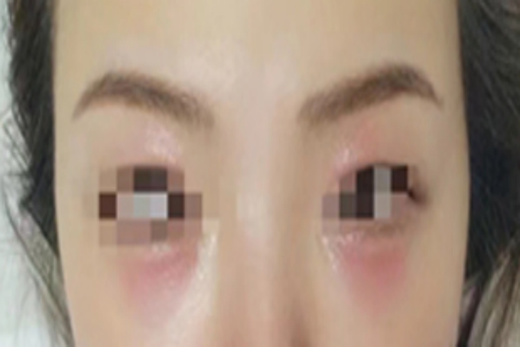 皮革皮炎眼睛周围发红图
