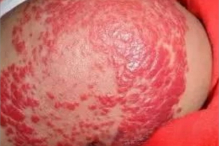 丛状血管瘤臀部皮肤上红斑图