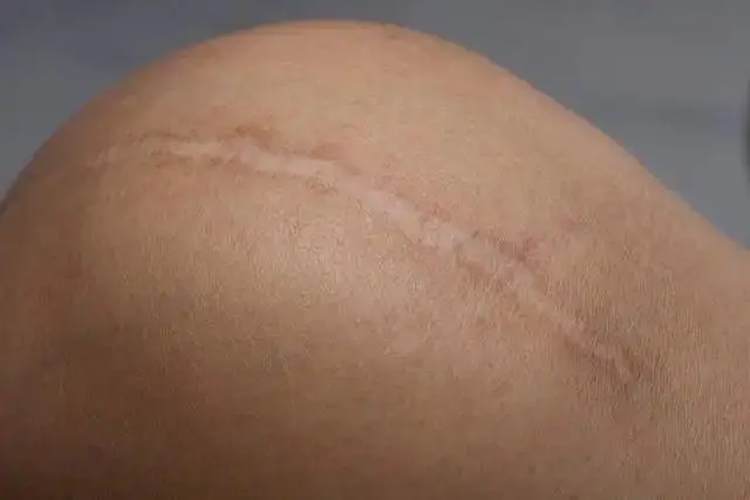 萎缩性瘢痕图 萎缩性瘢痕图